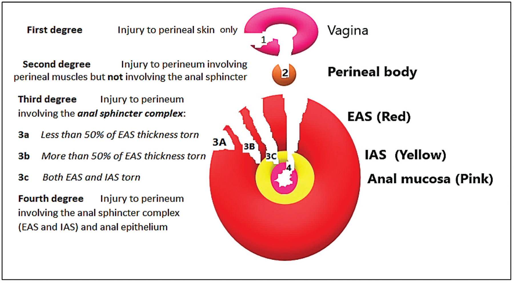 Ilustração médica esquemática das lesões perineais obstétricas (OASIS) por grau de severidade, sóbria, de ensino.