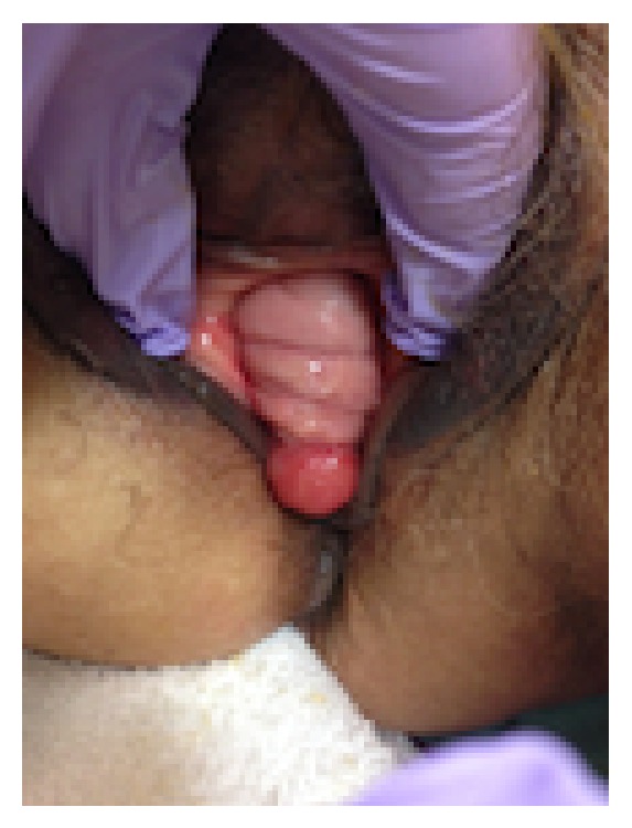 Exame demonstrando cistocele — parede vaginal anterior exteriorizada pelo introito.