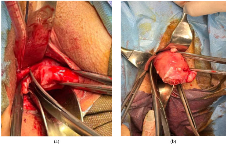 Fotografia intraoperatória de histerectomia vaginal: útero sendo exteriorizado pela via vaginal, seguro por pinças cirúrgicas.