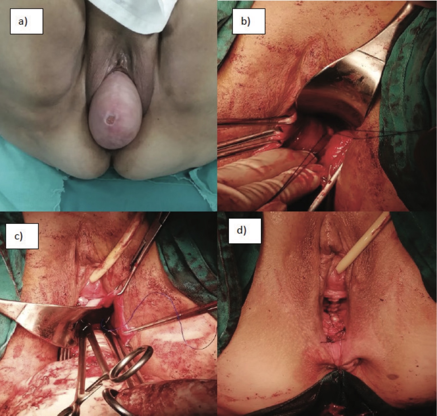 Painel a: eversão de cúpula vaginal pós-histerectomia (prolapso de cúpula) sem útero; os demais painéis mostram tempos de fixação sacroespinhosa por via vaginal.