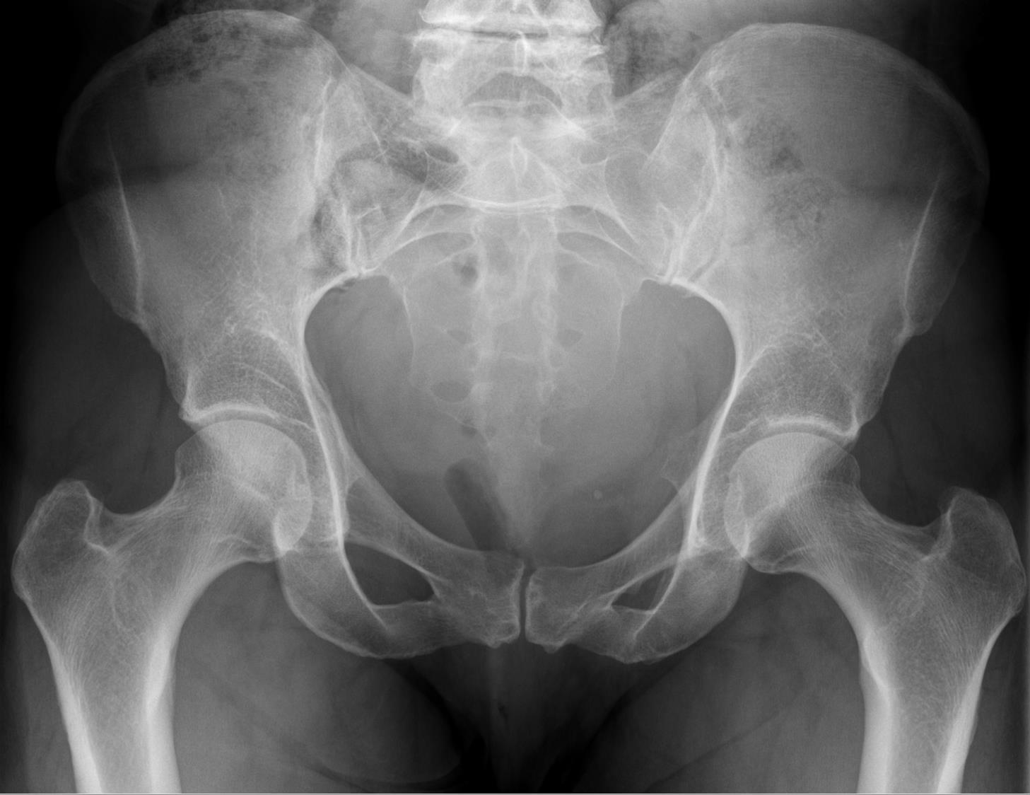Radiografia AP de pelve feminina adulta (45 anos)