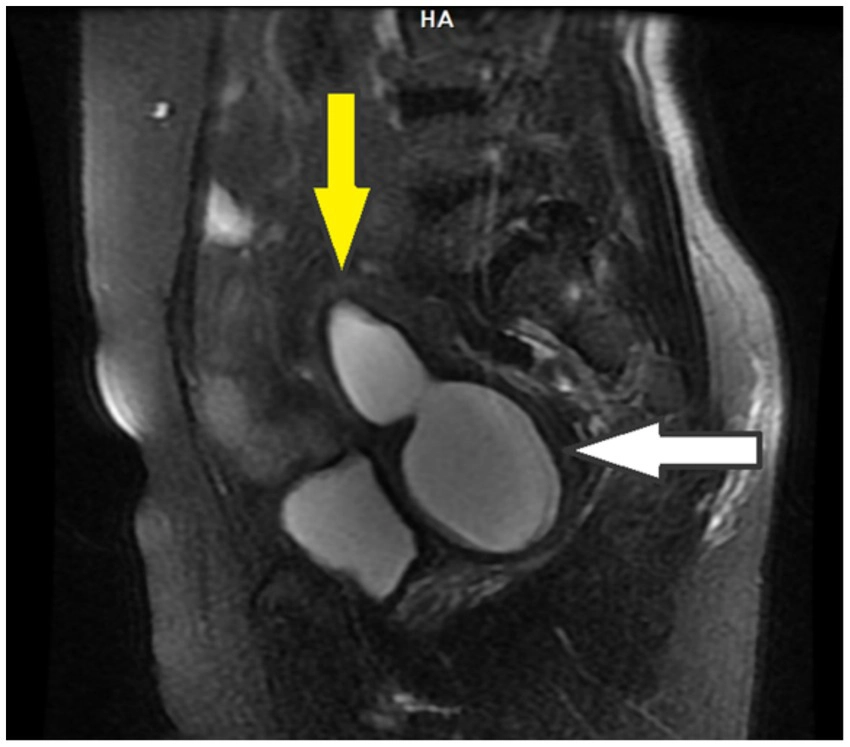Hematocolpo em imagem — padrão obstrutivo