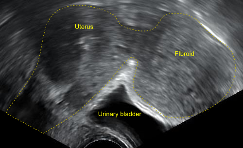Ultrassonografia transvaginal mostrando leiomioma uterino subseroso de cerca de 5 cm de diâmetro.