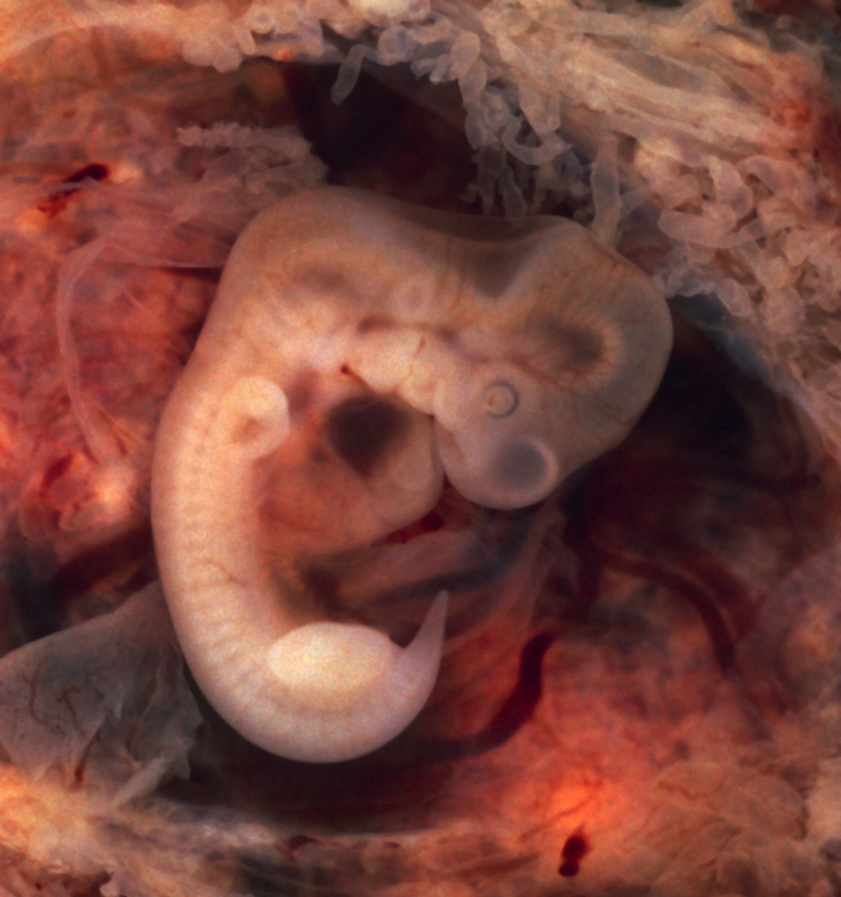 Macroscopia de tuba uterina aberta com gestação ectópica e embrião de cerca de 10 mm, cercado por vilosidades coriônicas.