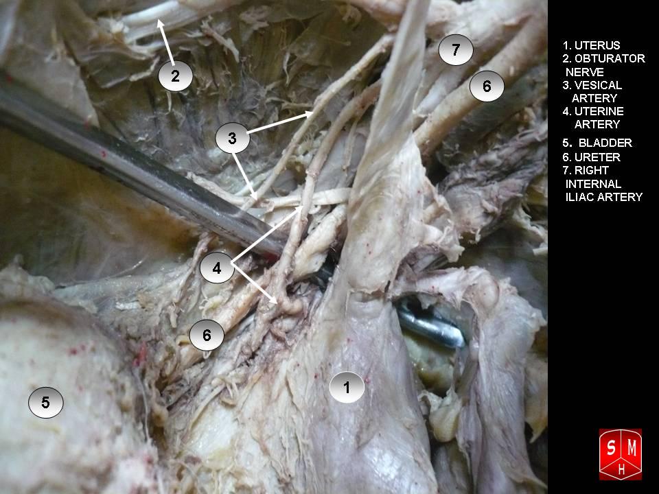 Dissecção anatômica mostrando ureter e artéria uterina em relação de cruzamento no campo pélvico.
