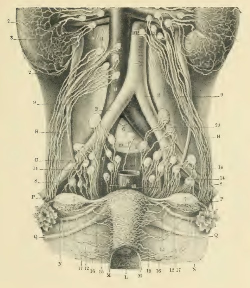 Prancha de atlas (Hirst, 1898): linfáticos das vísceras pélvicas e abdome, com aorta (A) e cadeias ilíacas (B).