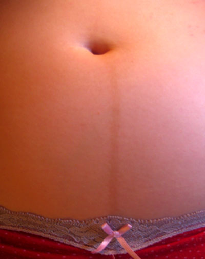 Abdômen de gestante de 22 semanas com linea nigra vertical hiperpigmentada.