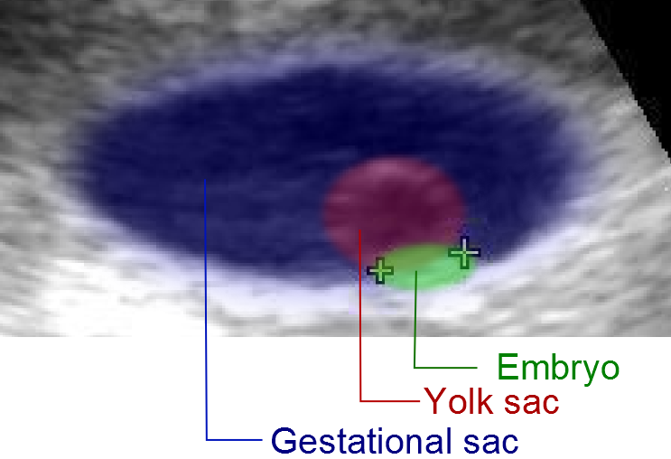 Ultrassom obstétrico colorido de cerca de 5 semanas: saco gestacional anecoico, embrião de 3 mm mensurável e vesícula vitelínica acima.