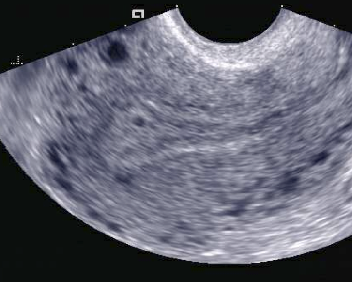 Ultrassom: saco gestacional intrauterino de 2 mm, sem vesícula vitelínica e sem embrião visíveis, correspondendo a aproximadamente 17 dias pós-concepção (~4 semanas).