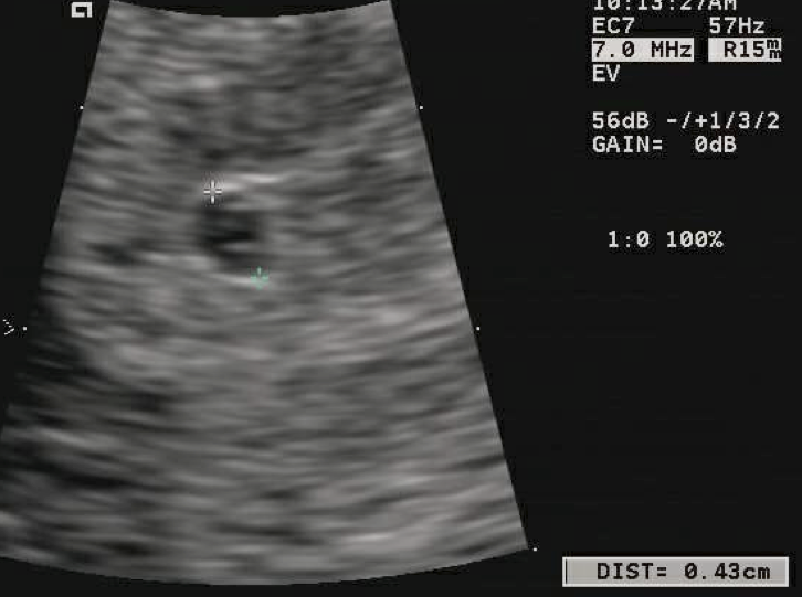 Ultrassom: saco gestacional intrauterino de 4 mm com vesícula vitelínica visível, sem embrião — compatível com aproximadamente 19 dias pós-concepção.