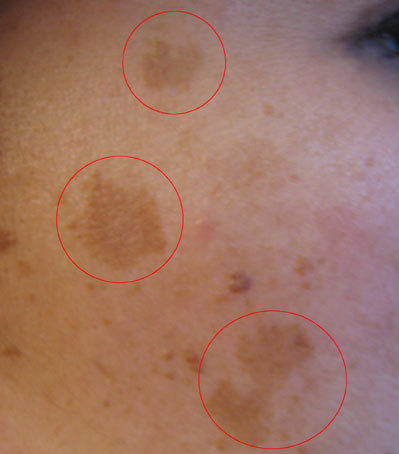Fotografia clínica de melasma facial (cloasma): hiperpigmentação em áreas malares e centrofacial.