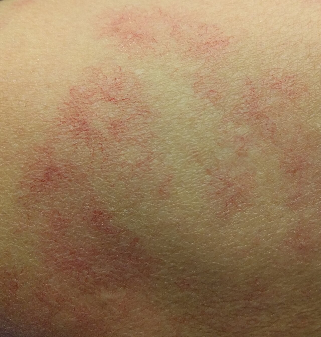 Fotografia clínica de múltiplas aranhas vasculares (spider angiomas) na pele.