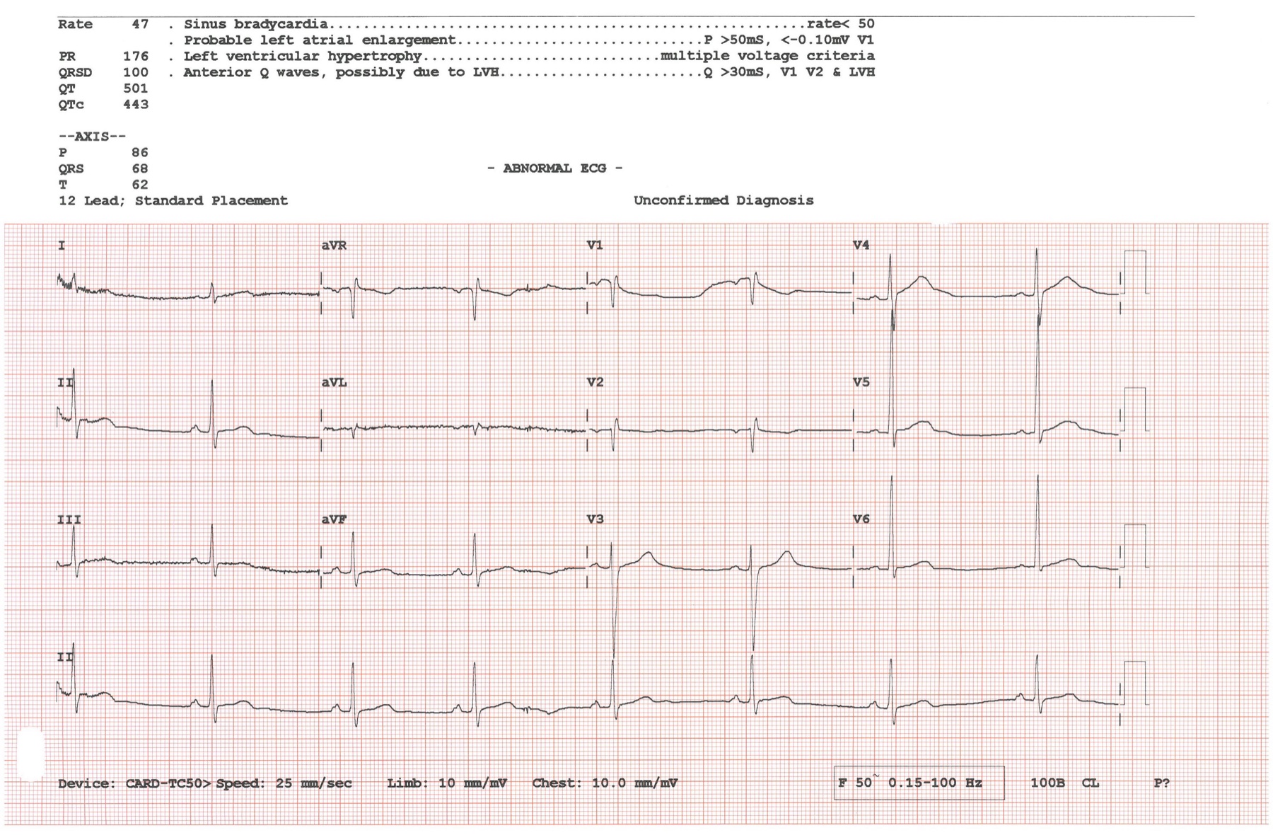 Eletrocardiograma de 12 derivações obtido em prática clínica.