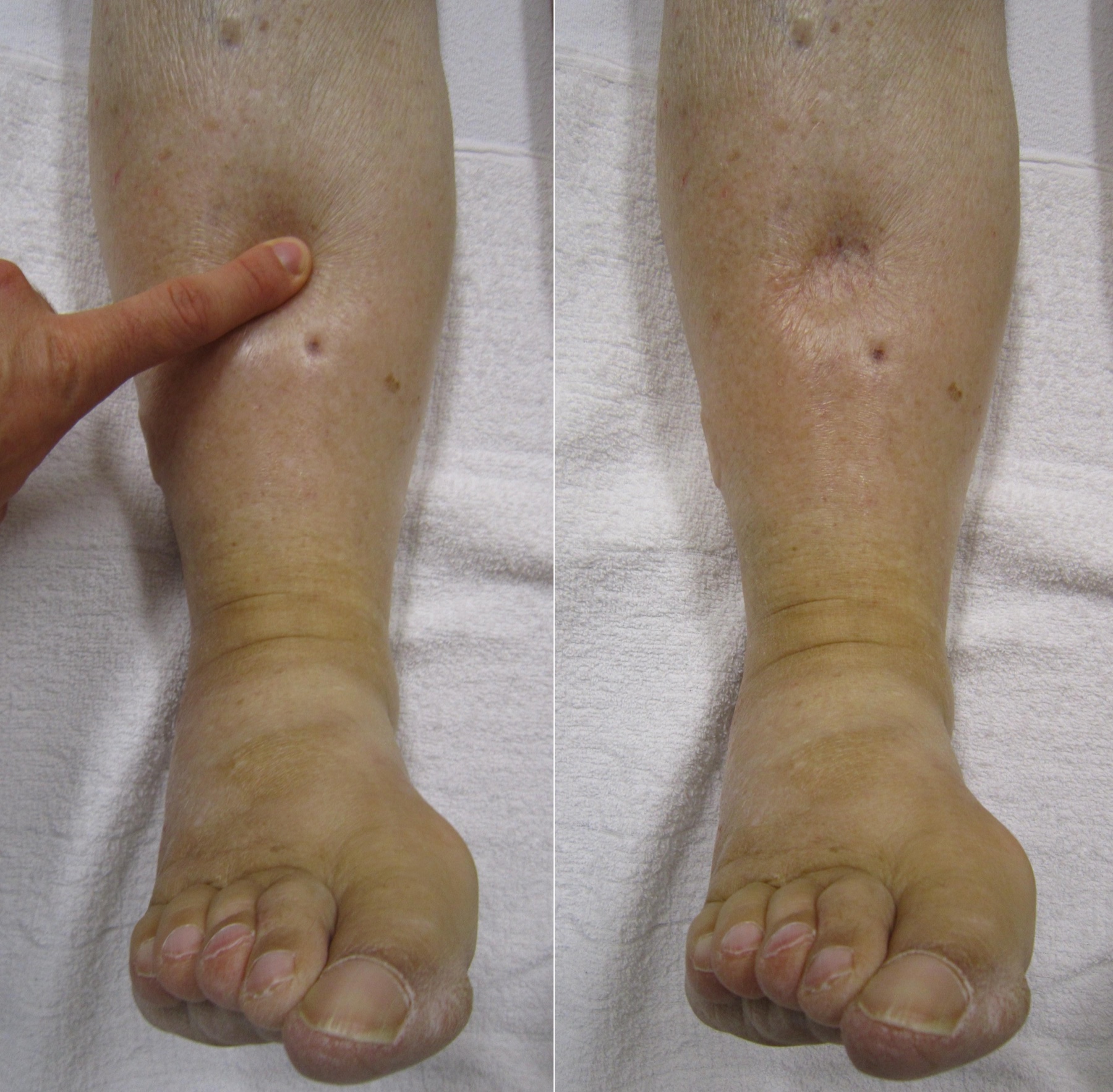 Edema de membros inferiores com sinal do godet: depressão cutânea após compressão digital.