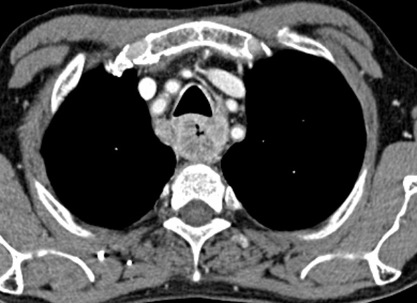 Tomografia de tórax em nível suprabifurcal mostrando espessamento parietal circunferencial do esôfago com captação de contraste, em contato com a árvore traqueobrônquica — doença localmente avançada cujo plano com a via aérea define o limite de ressecabilidade (T4).