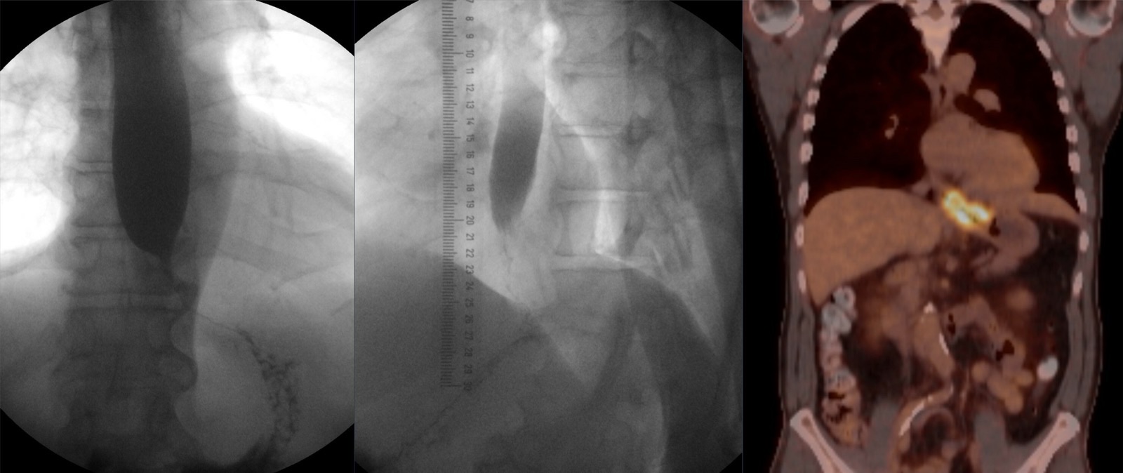 Painel duplo: à esquerda, esofagografia com bário mostrando estenose na junção esofagogástrica; à direita, PET-CT com captação intensa de FDG pelo tumor no mesmo nível — confirmação diagnóstica e estadiamento metabólico fechando o caso.