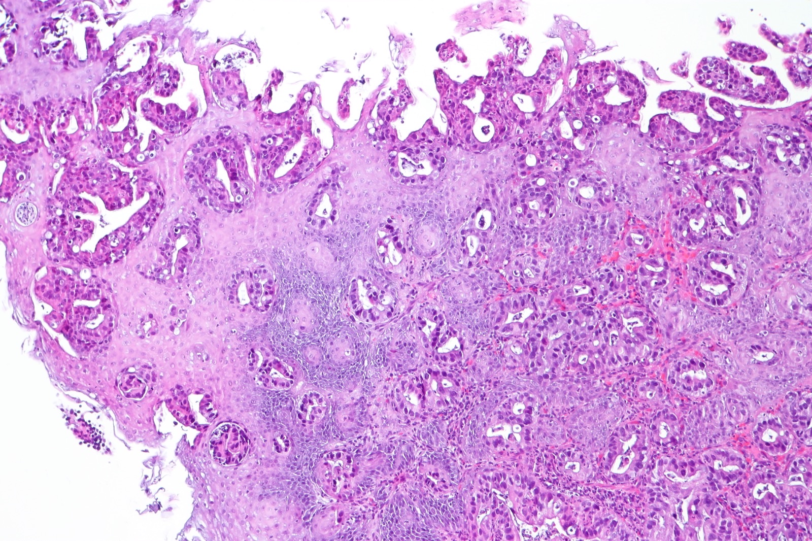 Histologia de adenocarcinoma de esôfago: glândulas tubulares neoplásicas irregulares infiltrando a lâmina própria, abaixo do epitélio escamoso de superfície — padrão glandular que define o adenocarcinoma ligado ao Barrett e ao terço distal.