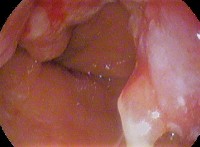 Endoscopia digestiva alta do esôfago distal mostrando lesão tumoral vegetante e irregular que estreita a luz do órgão — a obstrução mecânica progressiva que explica a disfagia de sólidos evoluindo para líquidos.