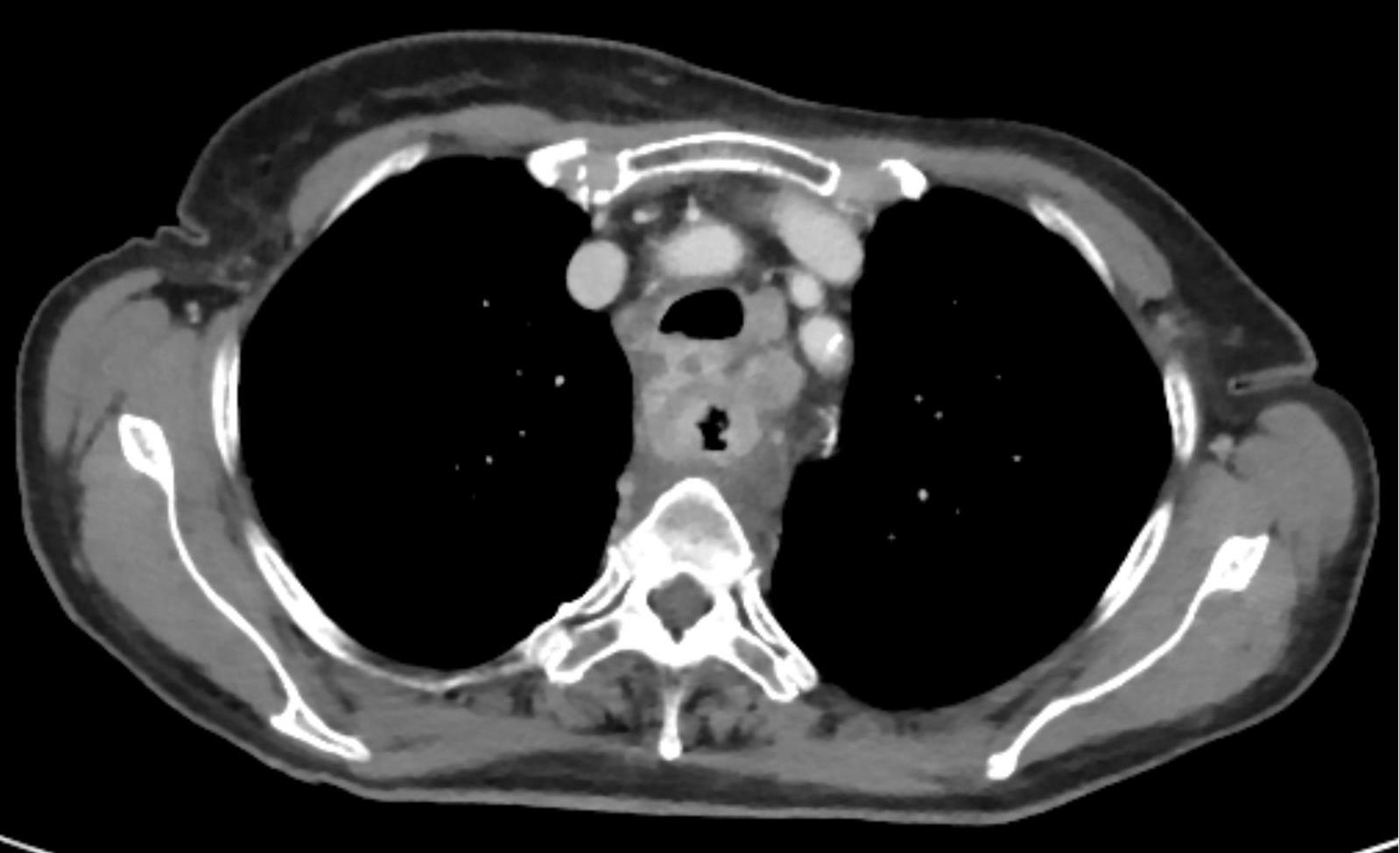 Tomografia de tórax em nível supracarinal mostrando espessamento parietal circunferencial do esôfago com realce e linfonodo mediastinal, com perda do plano gorduroso periesofágico — sinal de invasão por contiguidade que sustenta o estadiamento T/N.