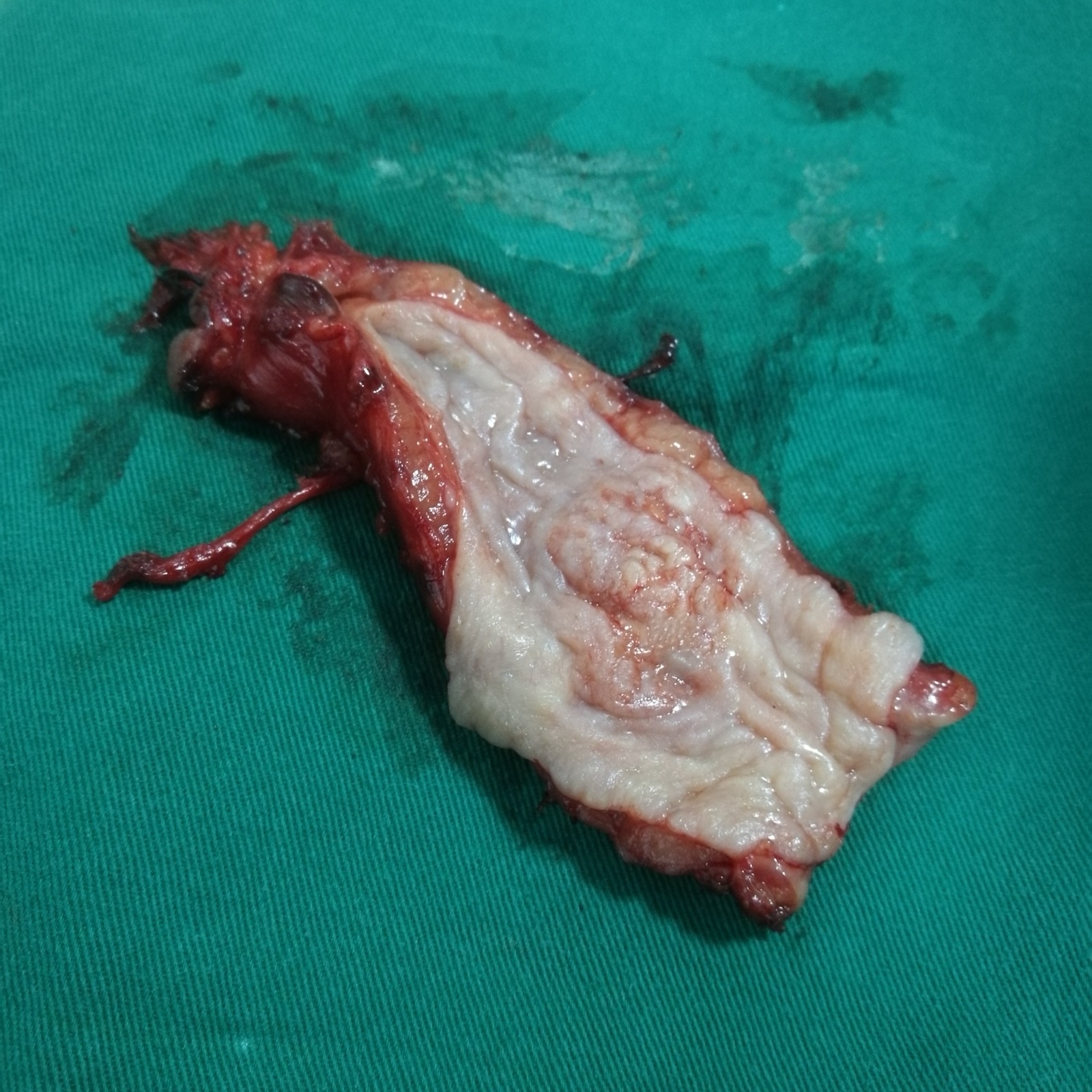 Peça cirúrgica de esofagectomia aberta longitudinalmente, com a massa tumoral exposta na mucosa — correlação macroscópica do tumor que define margens e estadiamento patológico após a ressecção.