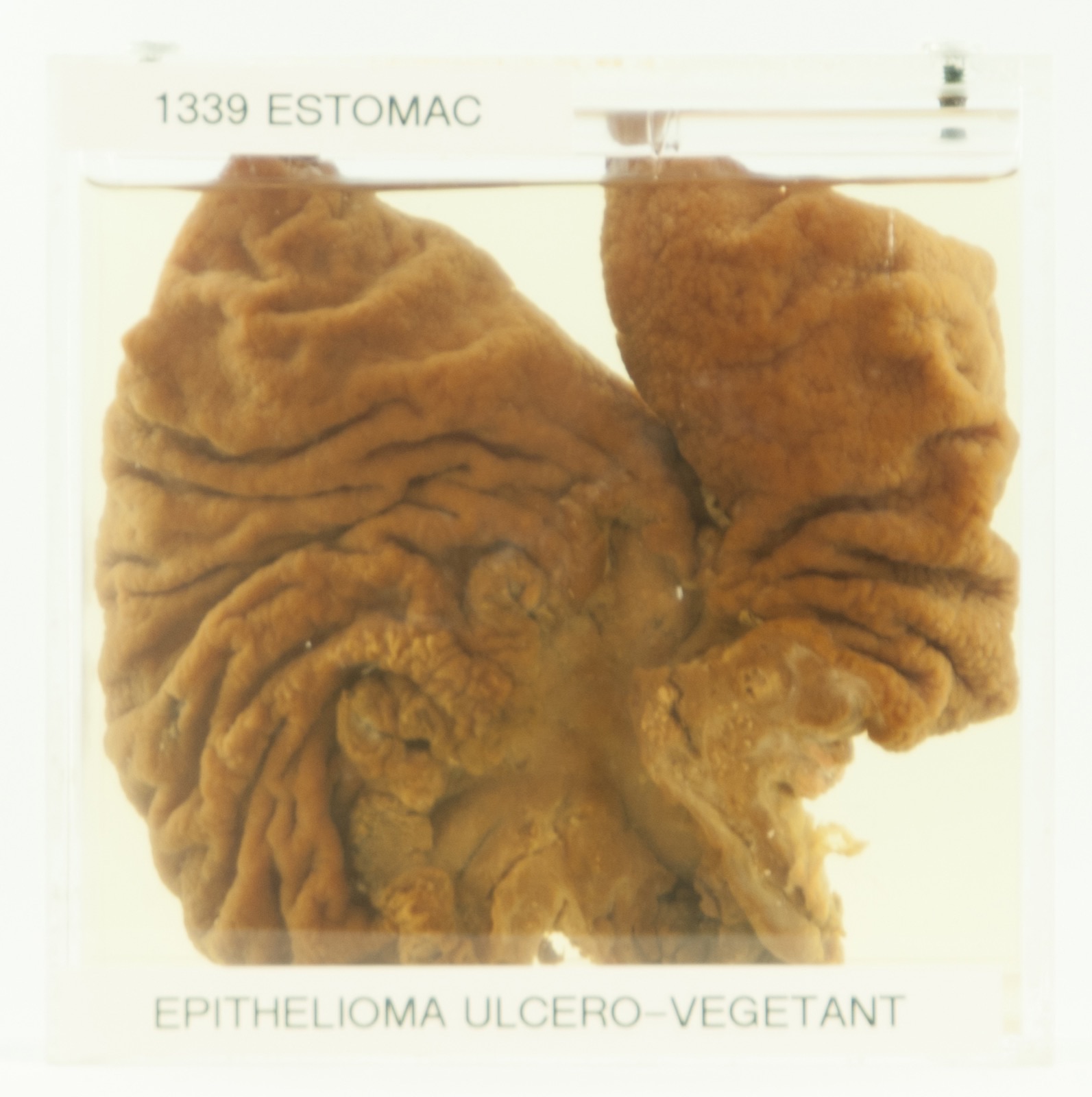 Peça macroscópica de adenocarcinoma da cárdia gástrica: tumor úlcero-vegetante extenso, proximal, infiltrando toda a espessura da parede do estômago.