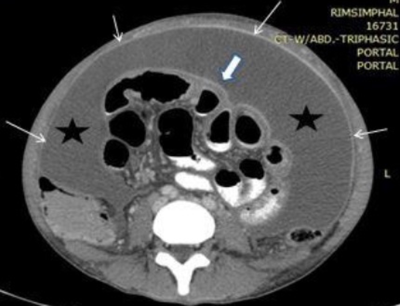 Tomografia computadorizada de abdome mostrando espessamento peritoneal com fixação central e ascite volumosa — implantes peritoneais da carcinomatose.