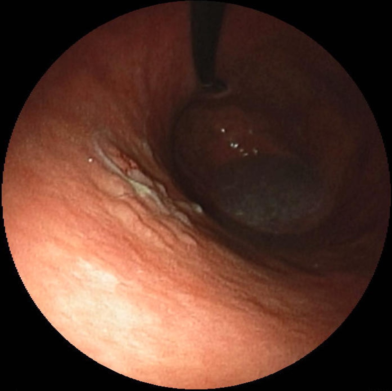 Endoscopia digestiva alta de câncer gástrico precoce: lesão pequena, levemente deprimida e avermelhada, restrita à mucosa.
