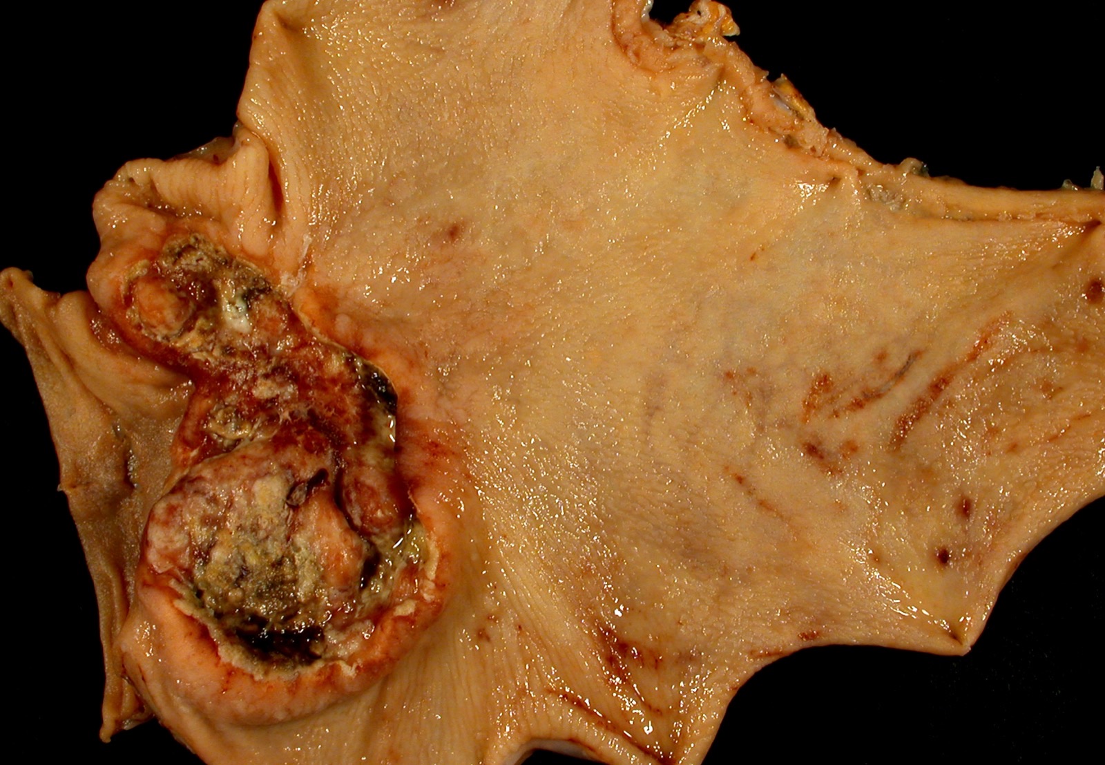 Peça de gastrectomia: tumor vegetante-ulcerado de cerca de 7 cm no antro gástrico, com a margem duodenal à esquerda.
