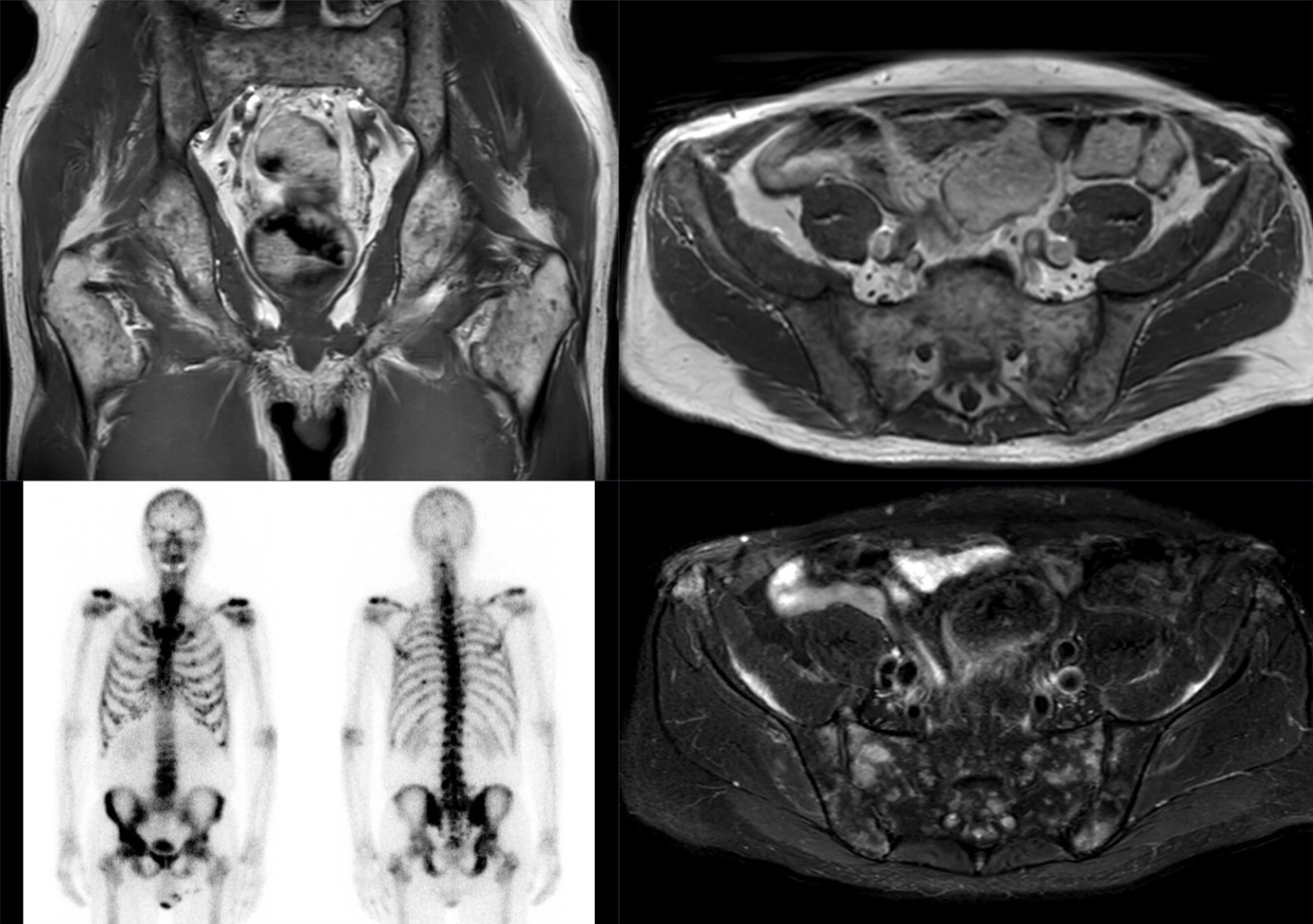 Ressonância magnética (T1 coronal e axial, T2 SPAIR) e cintilografia óssea mostrando múltiplas metástases ósseas de adenocarcinoma gástrico de células em anel de sinete.