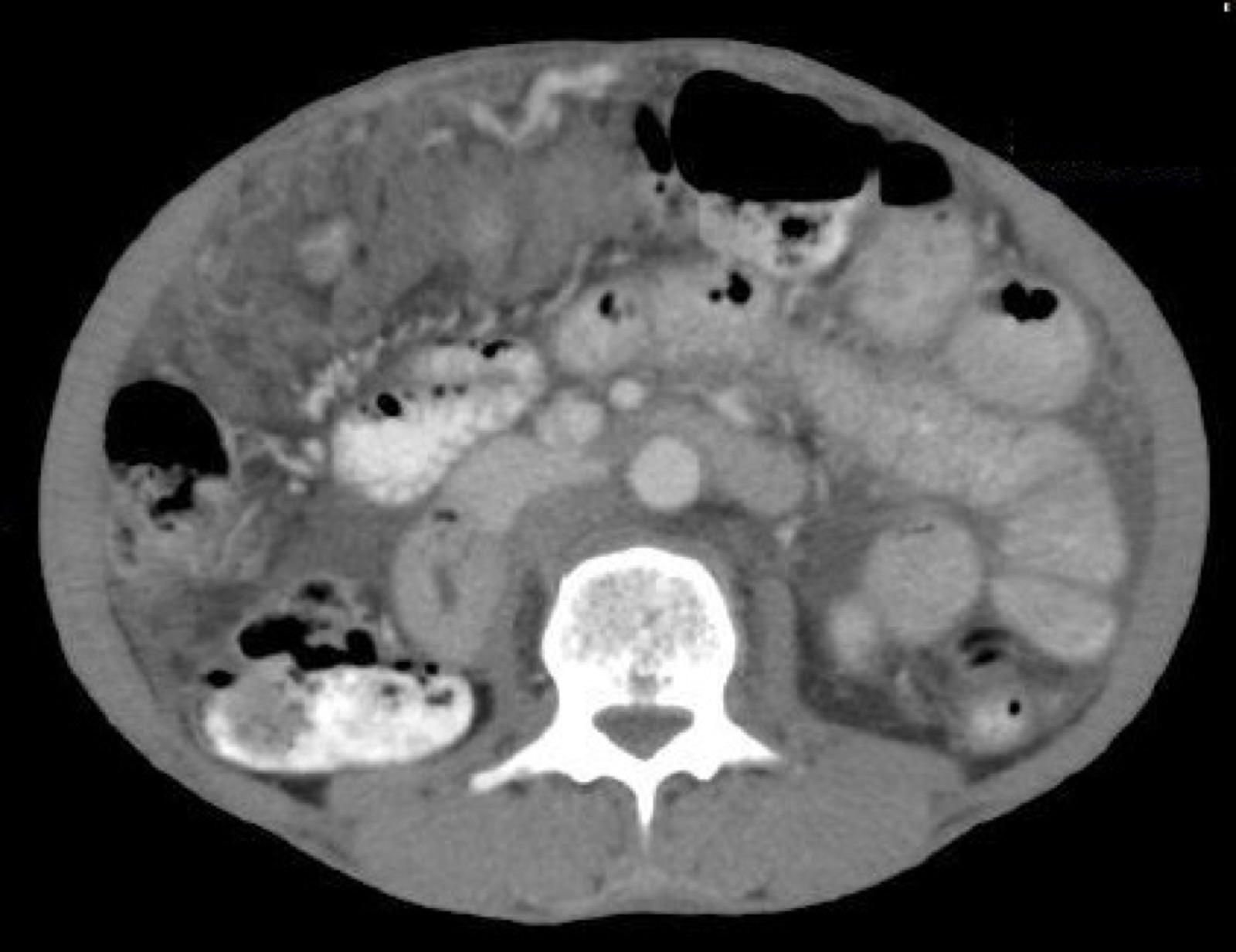 Tomografia computadorizada de abdome com omental cake: espessamento nodular do grande omento captando contraste, sobre ascite.