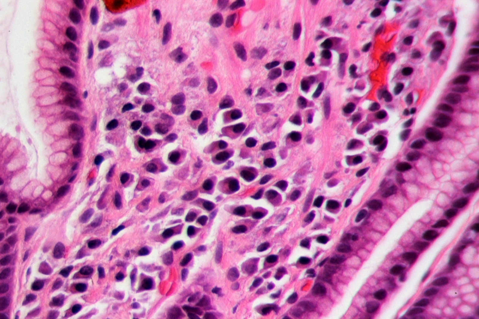 Micrografia (hematoxilina-eosina) de gastrite por Helicobacter pylori: infiltrado inflamatório crônico na lâmina própria com bacilos curvos na superfície da mucosa foveolar.