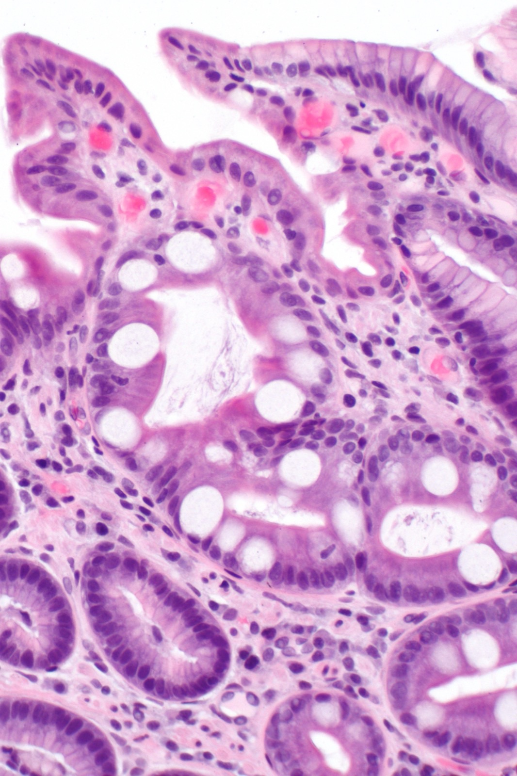 Micrografia (hematoxilina-eosina) de metaplasia intestinal gástrica: epitélio gástrico substituído por epitélio do tipo intestinal com células caliciformes, sobre inflamação crônica.