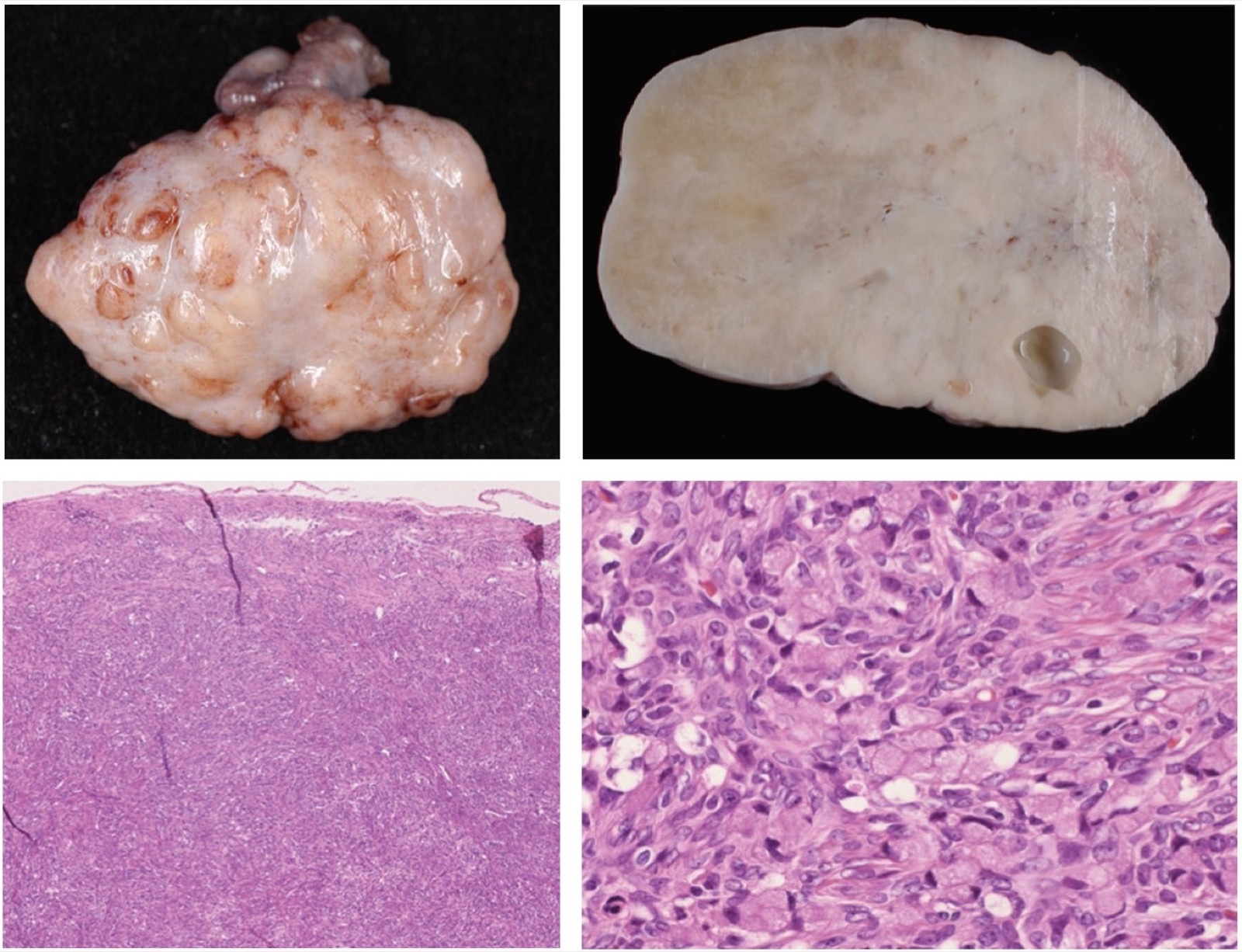 Tumor de Krukenberg: peça macroscópica do ovário em corte ao lado de histologia (HE) de carcinoma de células em anel de sinete metastático ao ovário.