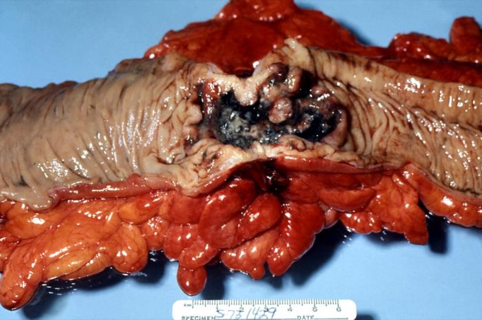 Peça cirúrgica de cólon aberta mostrando adenocarcinoma ulcerado e endofítico; a úlcera tumoral é a porta de entrada do S. bovis na corrente sanguínea.