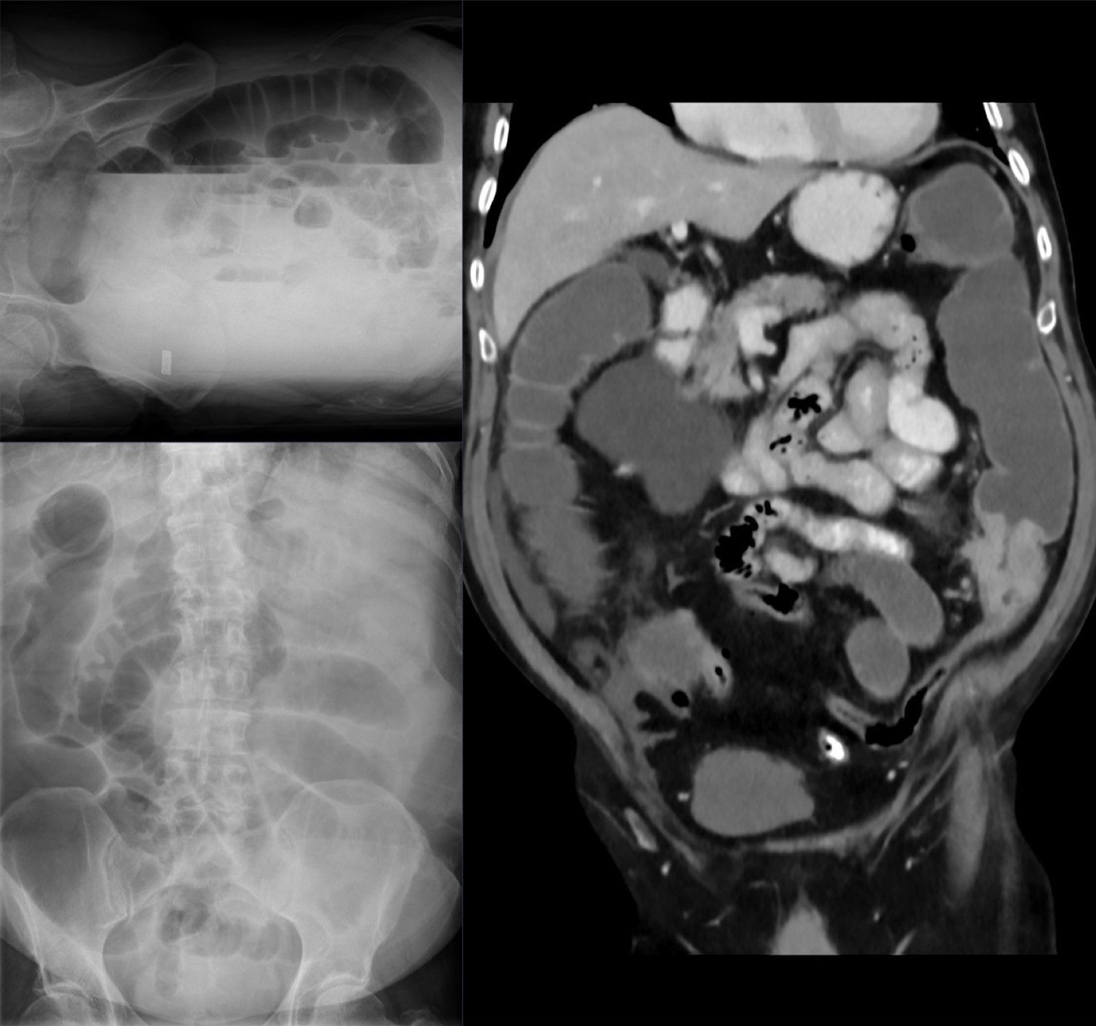 Radiografia e TC coronal de cólon descendente com carcinoma estenosante: grande tumor com salto de calibre e alças dilatadas a montante por obstrução.