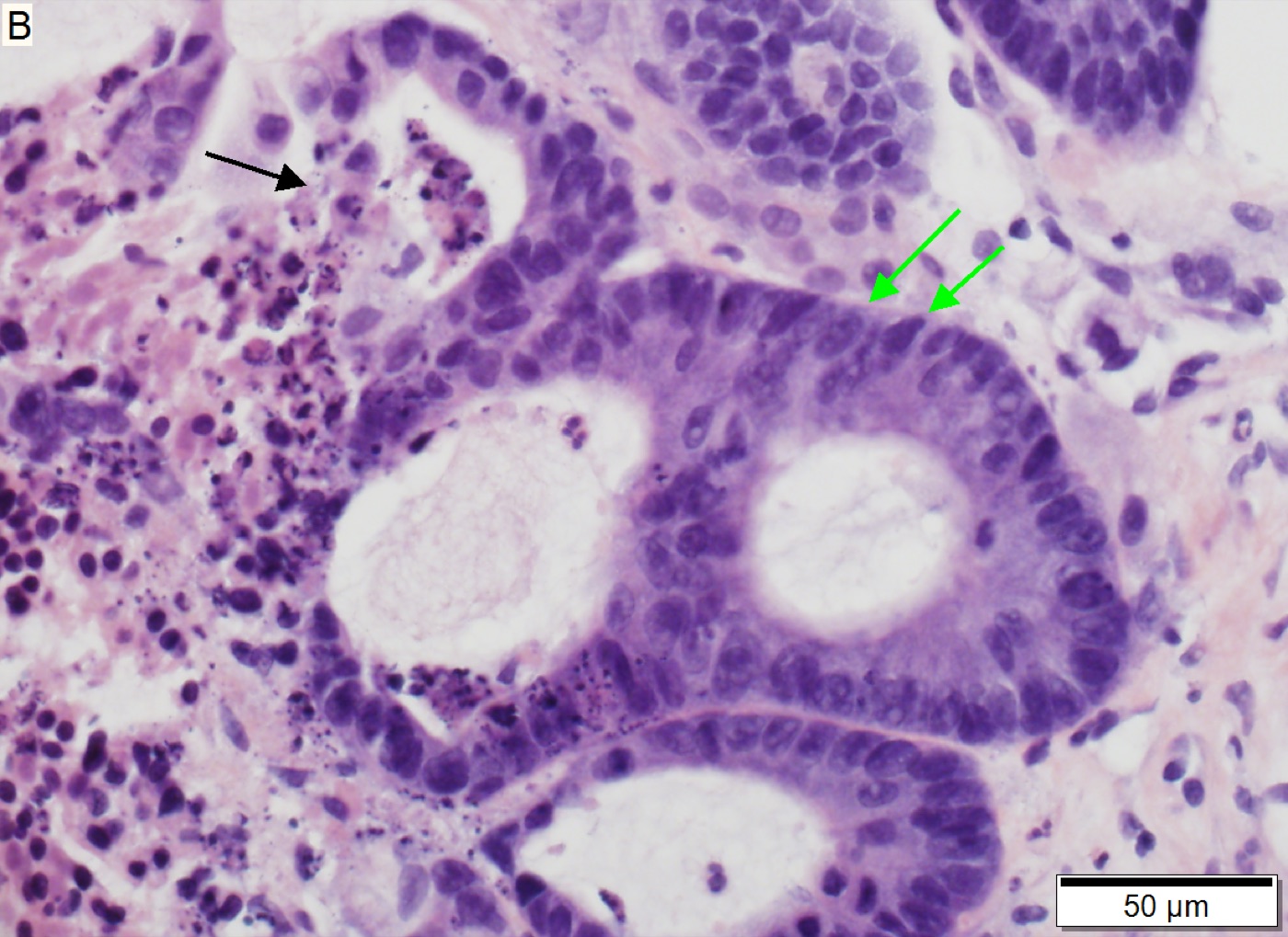 Peça de fígado com metástase de carcinoma colorretal: nódulo metastático em parênquima hepático, a lesão que, sendo limitada e ressecável, permite tratamento com intenção curativa.
