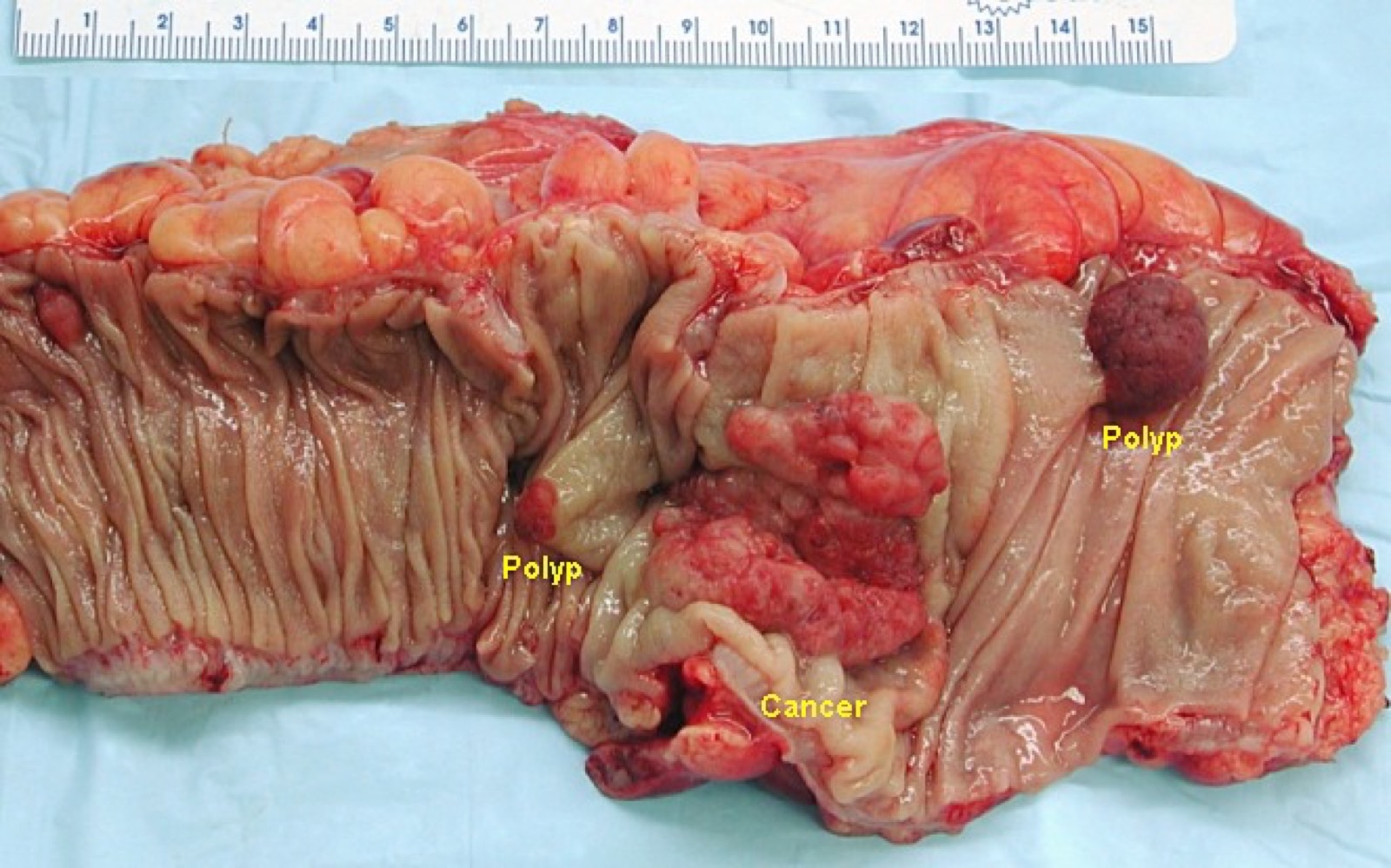 Peça de colectomia com carcinoma colorretal invasivo e dois pólipos adenomatosos no mesmo segmento de cólon.