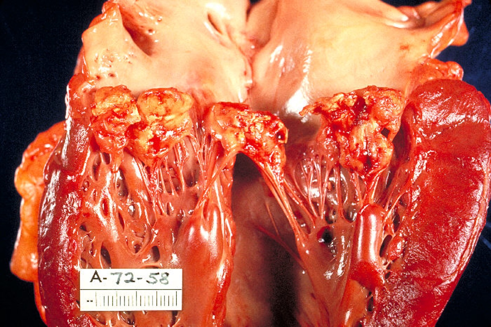 Peça de autópsia com o coração aberto mostrando vegetações de endocardite infecciosa aderidas à valva — a lesão que gera o sopro de regurgitação novo do caso.