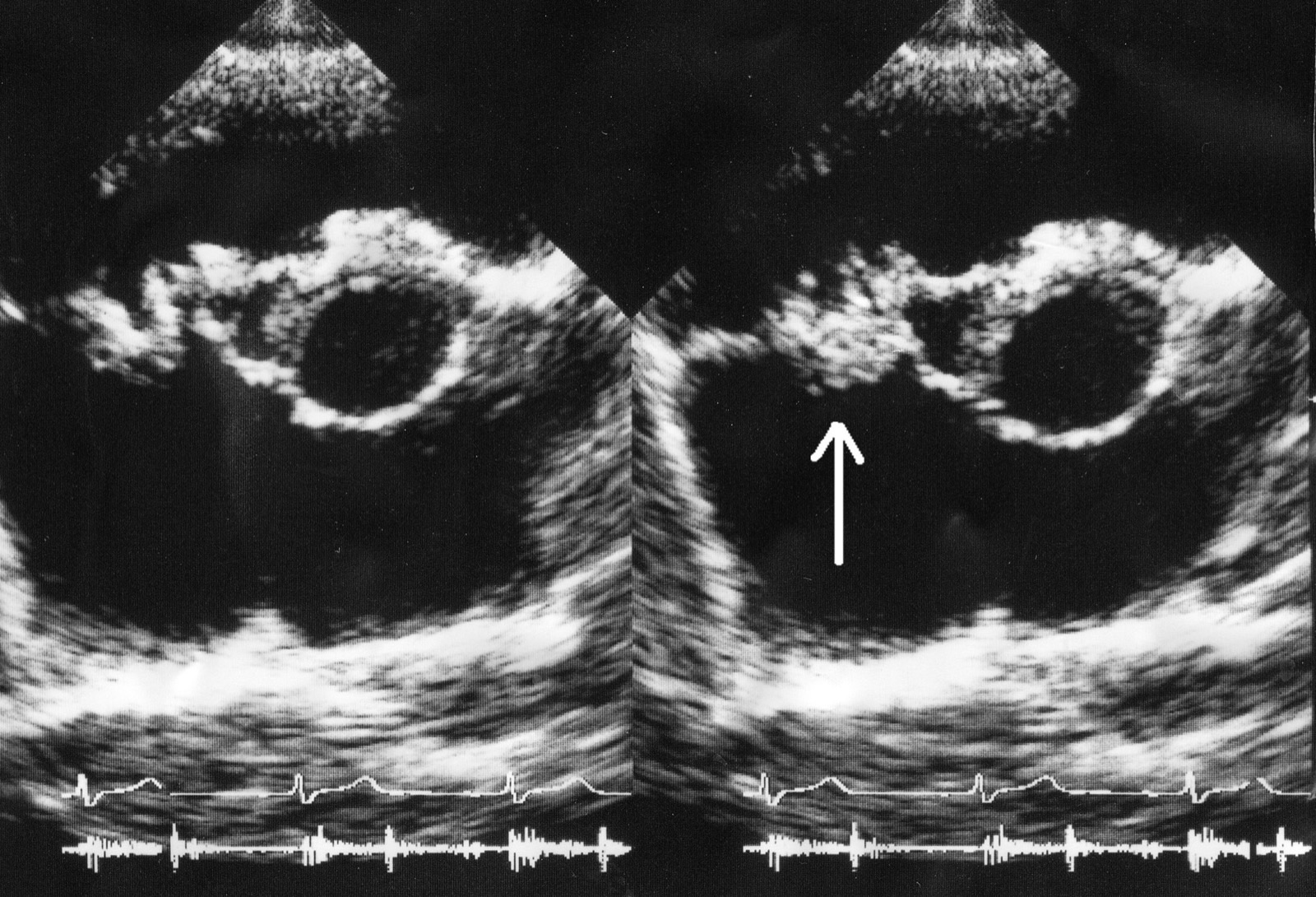 Ecocardiograma mostrando vegetação valvar: massa ecogênica aderida à valva, achado de envolvimento endocárdico que é critério maior de Duke.