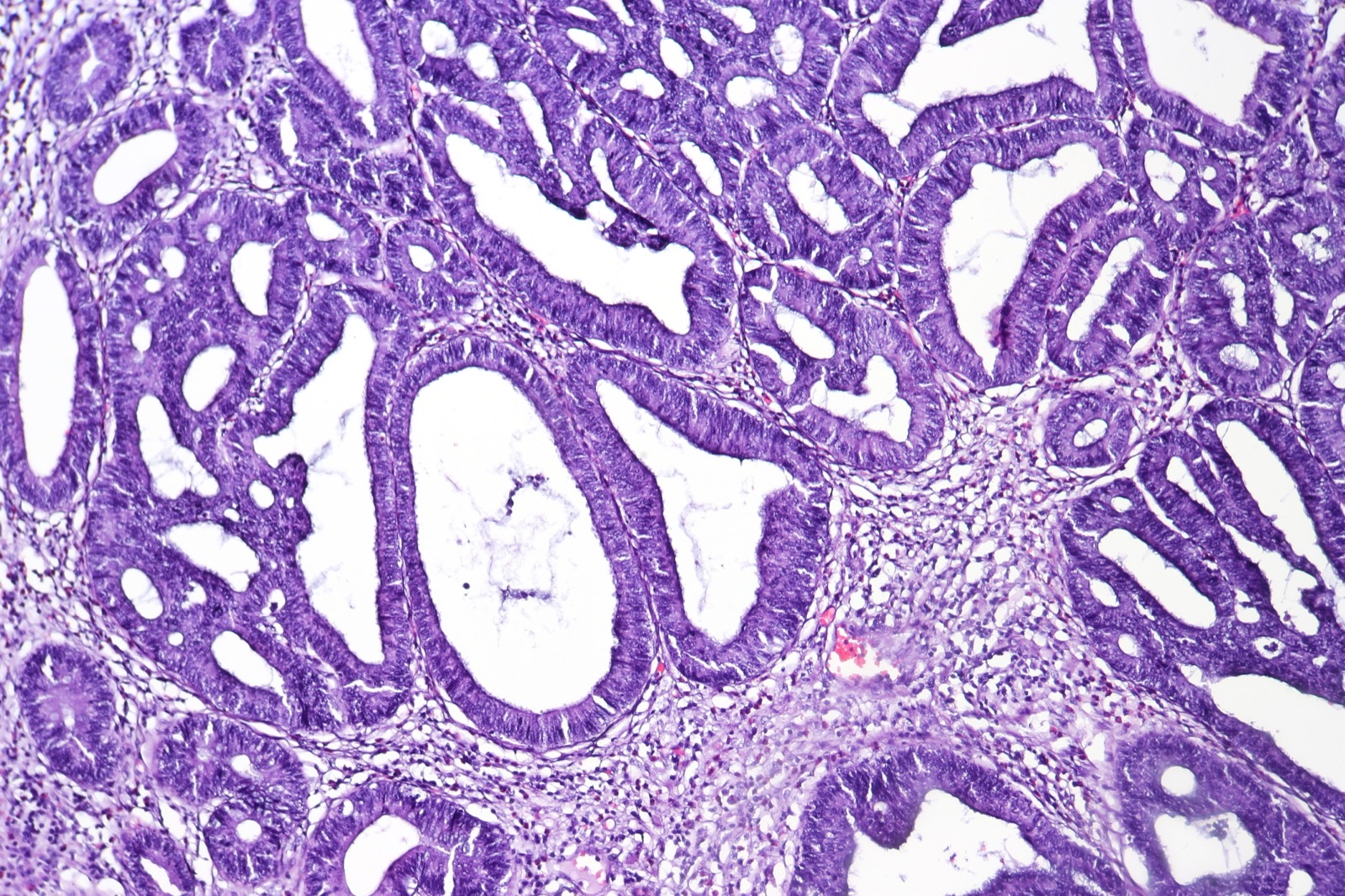 Histologia (HE) de adenoma de cólon com displasia de alto grau: pleomorfismo nuclear e arquitetura glandular irregular, o degrau pré-maligno da sequência adenoma-carcinoma.