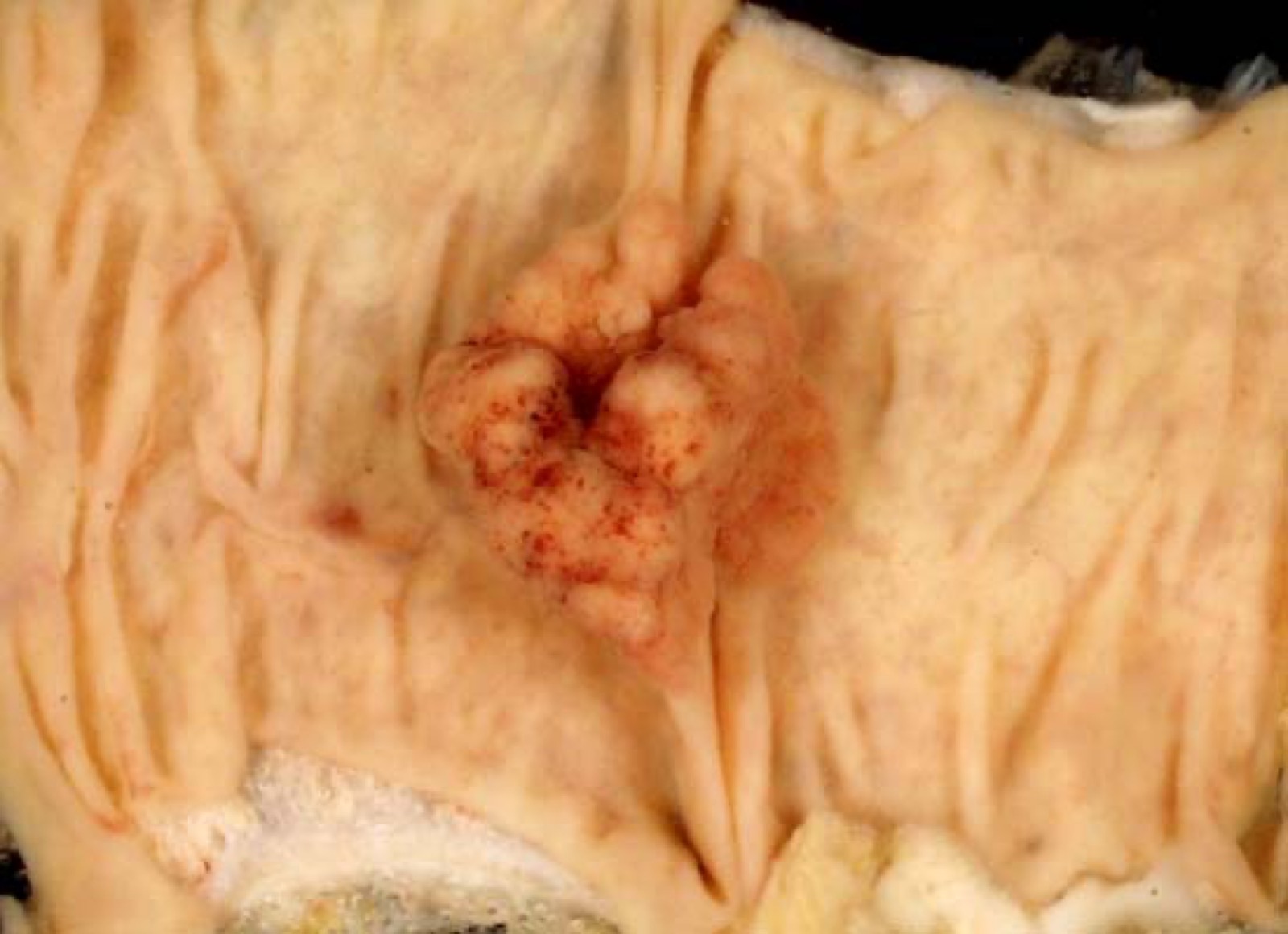 Peça de cólon mostrando pólipo adenomatoso pediculado de cerca de 2,5 cm na mucosa: a lesão-alvo do rastreio.