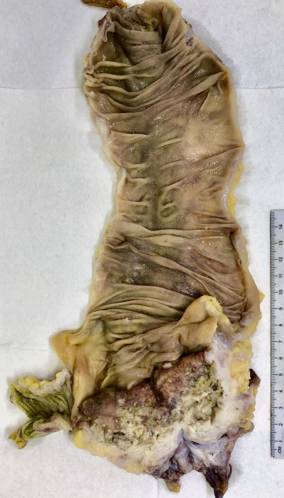 Peça de colectomia direita: adenocarcinoma de ceco volumoso que invade a parede de um segmento de cólon de calibre largo.