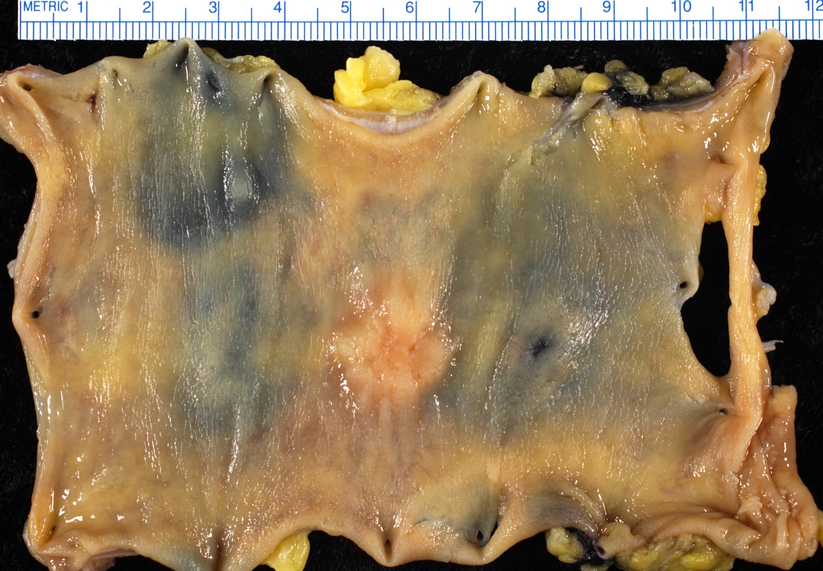 Adenocarcinoma de cólon sigmoide visto en face: tumor anular em segmento de calibre menor, que tende a obstruir.