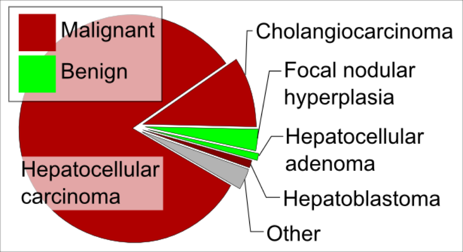 Gráfico de barras dos tipos de tumor hepático no adulto por incidência relativa: o hemangioma (benigno) na frente, seguido das metástases e do hepatocarcinoma, com adenoma e hiperplasia nodular focal entre os benignos.