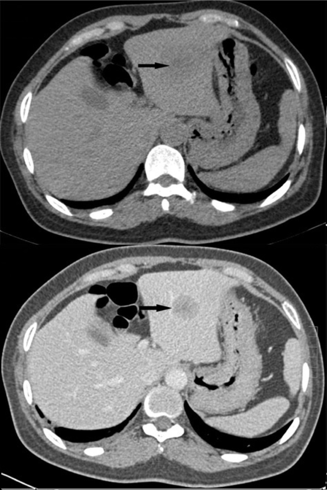 TC de hepatocarcinoma sem contraste (cima) e com contraste (baixo): a lesão hepática indicada por seta, que será estadiada por Child e Milão.