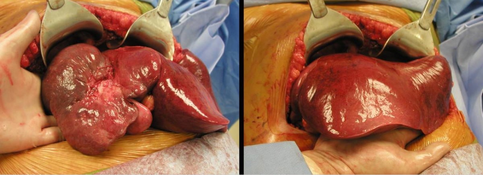 Fotos intraoperatórias do fígado: à esquerda, o tumor reduzido e fibrosado; à direita, o lobo esquerdo hipertrofiado após embolização/ligadura portal, permitindo a hepatectomia direita.