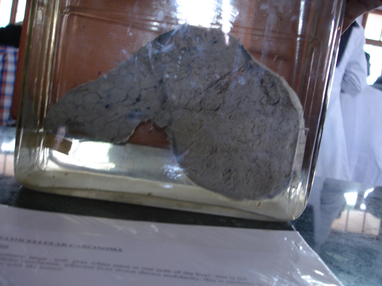 Peça macroscópica de fígado com hepatocarcinoma: parênquima nodular acinzentado, com a lesão tumoral identificada — correlação entre o que a TC dinâmica mostrava e a patologia.