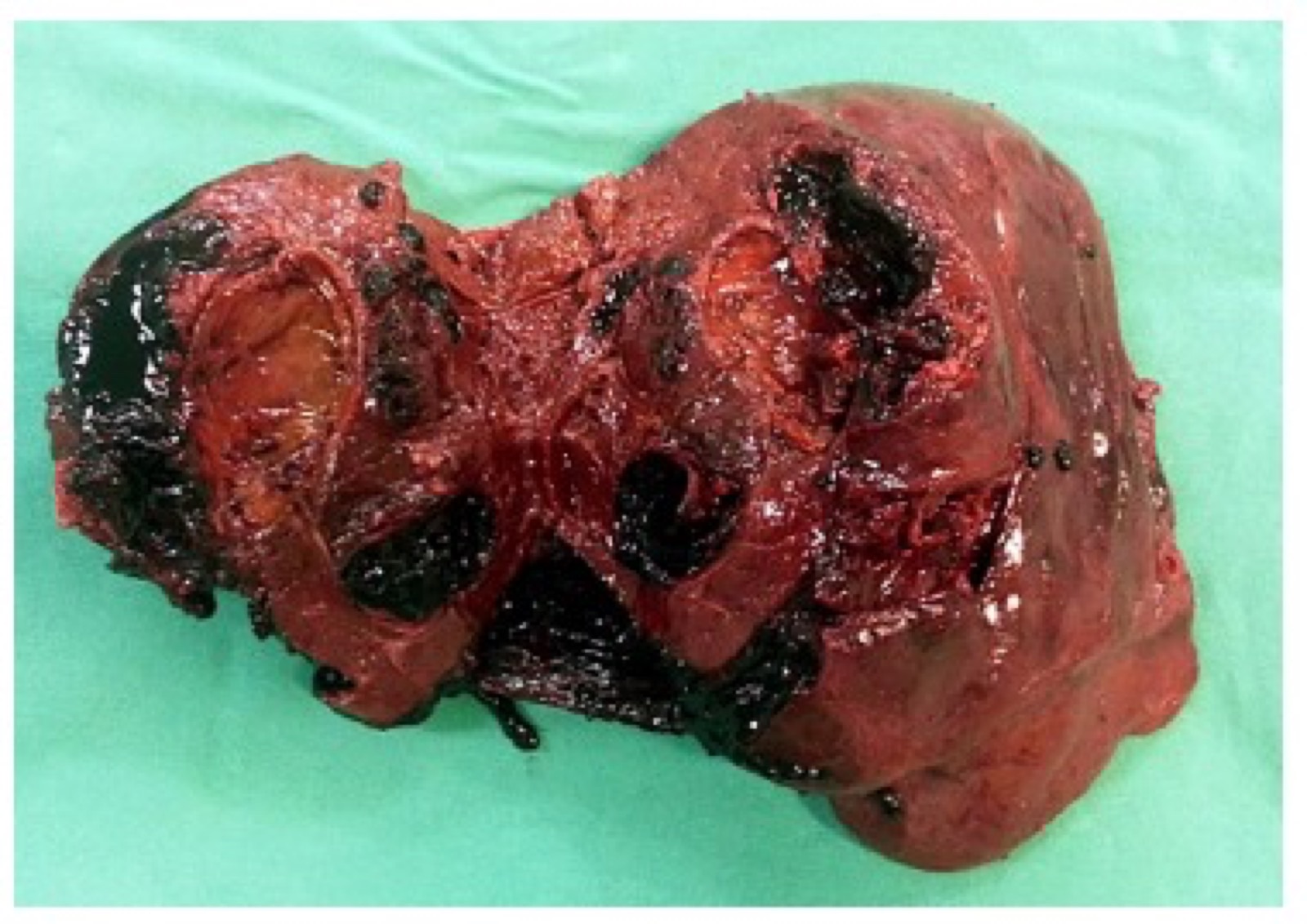 Peça cirúrgica: lobo hepático direito aberto mostrando o adenoma e múltiplos coágulos de sangue infiltrando o parênquima — o adenoma roto que sangrou até o choque.