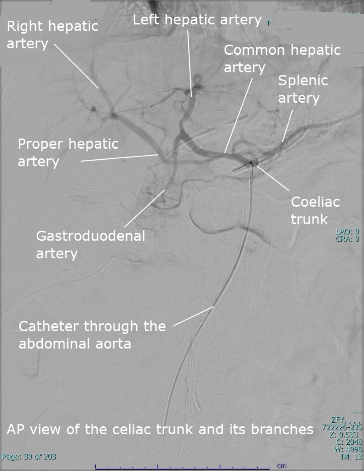 Angiografia do tronco celíaco com a árvore arterial hepática: artéria hepática própria, comum, direita e esquerda, e gastroduodenal, opacificadas pelo contraste por cateter.