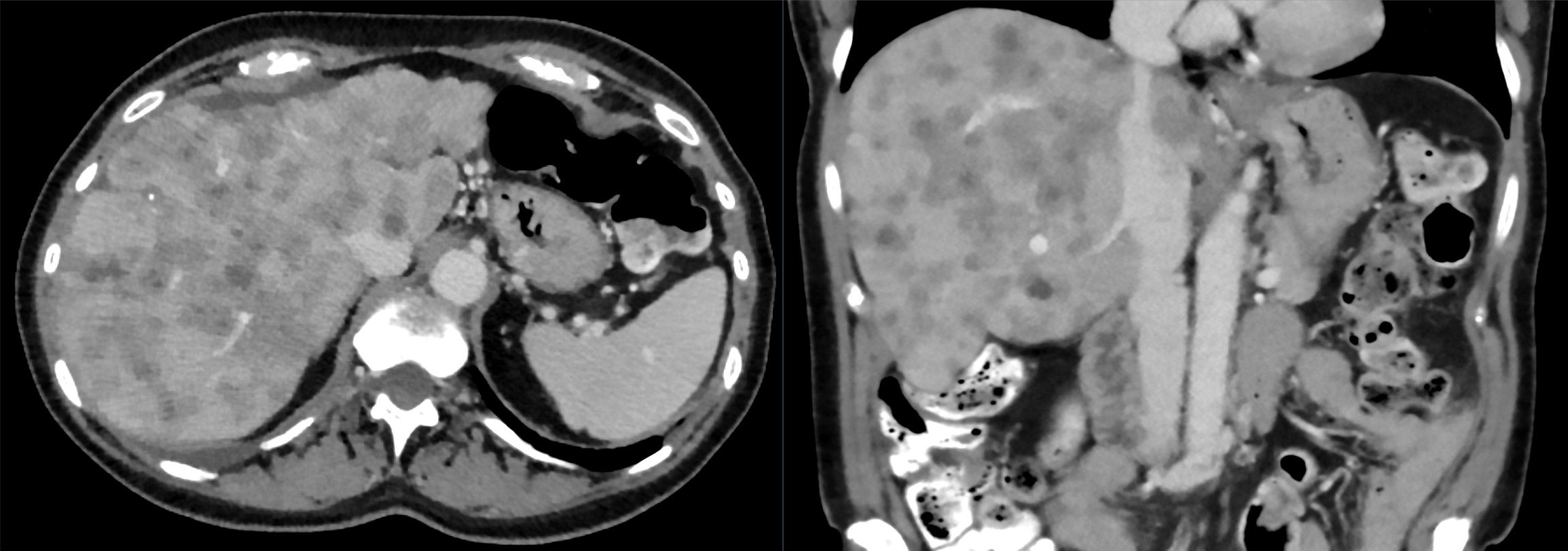 TC de abdome com contraste na fase portal-venosa, cortes axial e coronal: fígado crivado de múltiplos nódulos hipodensos (hipocaptantes) em ambos os lobos — metástases hepáticas hipovasculares, o padrão de captação que aponta lesão vinda de fora (metástase).